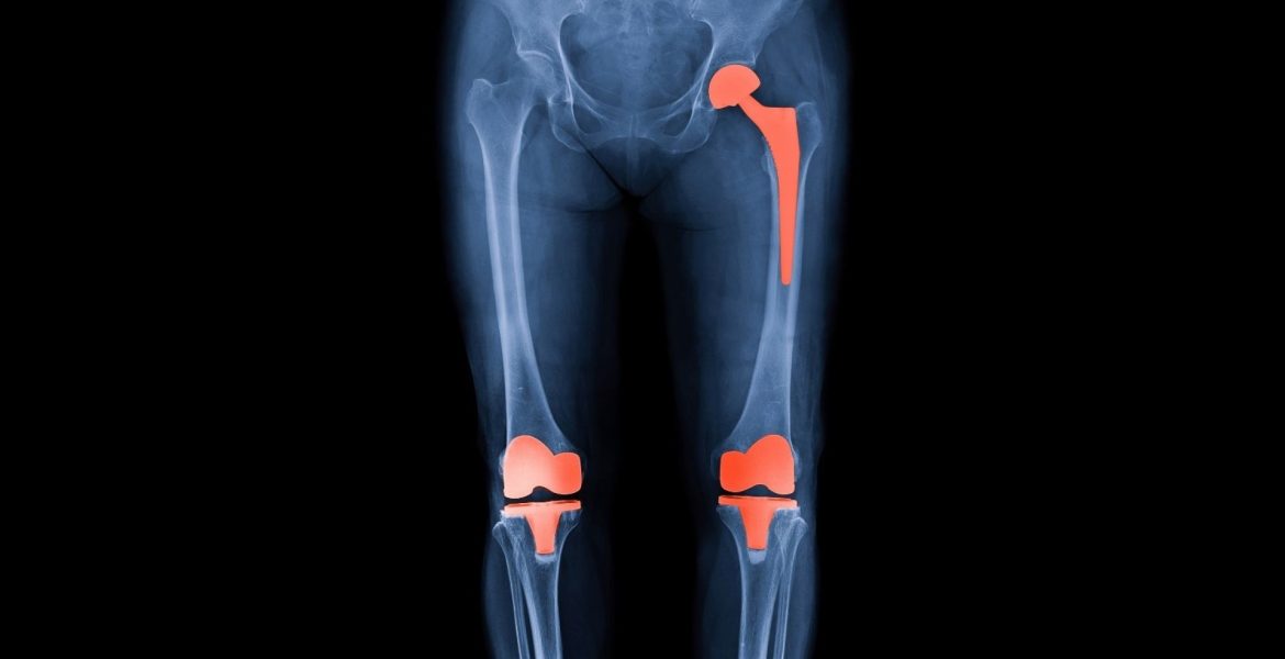 Professionelle Adipositas-Chirurgie-Operationen unter der Leitung von Fachärzten bei Ibni Sina Health.